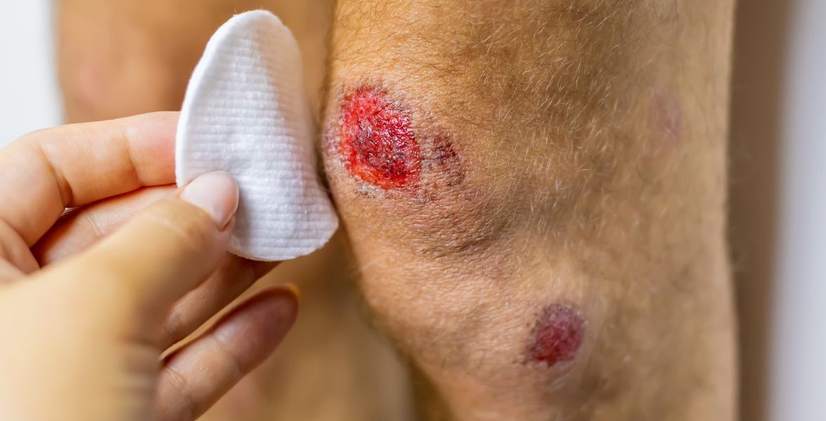 Stages of Wound Healing