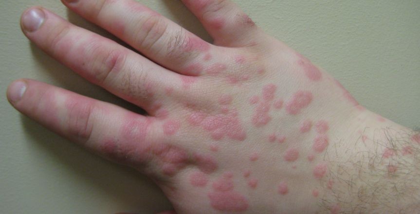 Erythema Multiforme